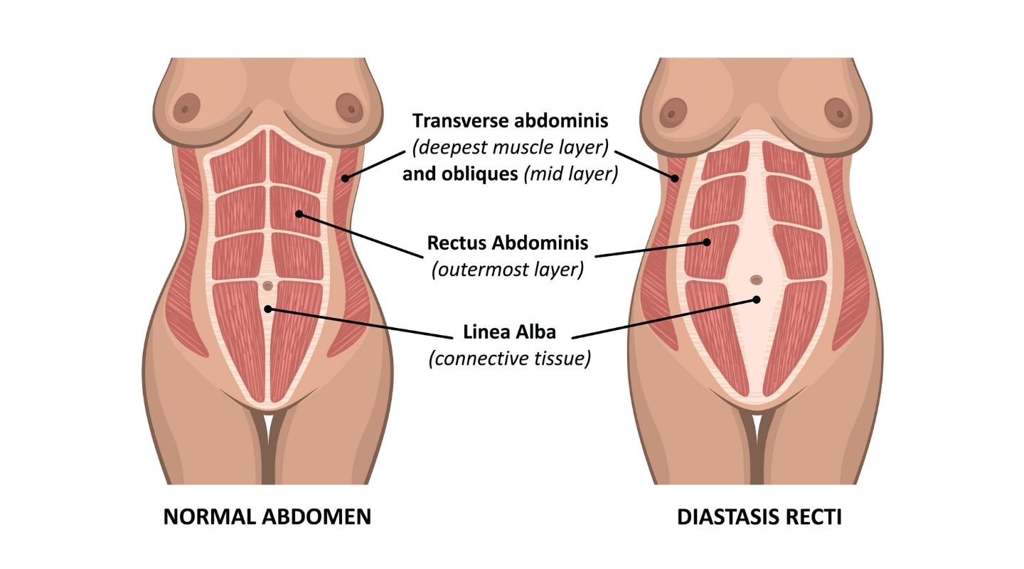 diastasis recti abdominis